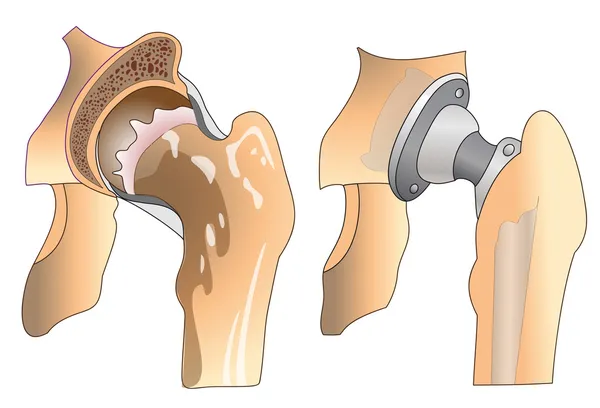 Prótesis de cadera — Vector de stock