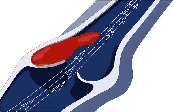 Bildandet av en blodpropp (trombos) i större venerna i området — Stock vektor