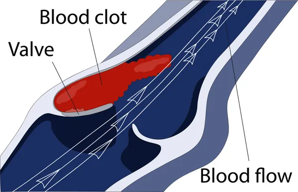 下肢静脉血栓形成 — 图库矢量图片