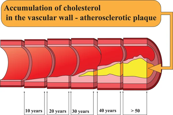 Накопление холестерина в стенках сосудов. Плакат — стоковый вектор
