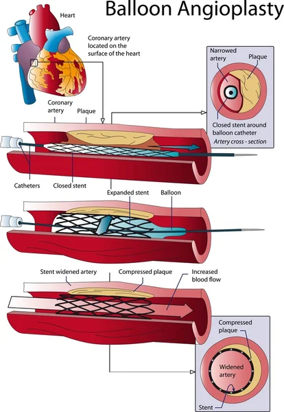 Angioplastia com balão — Vetor de Stock