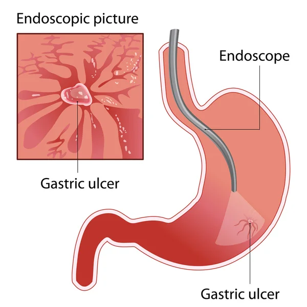 Ulcera gastrica — Vettoriale Stock