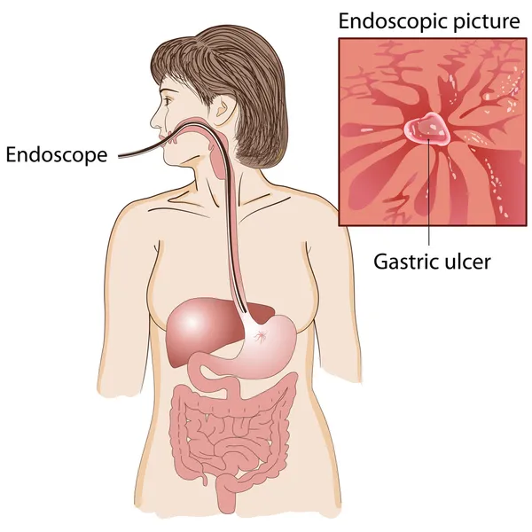 Endoscopie — Image vectorielle