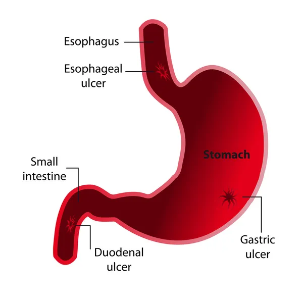Ulcera gastrica — Vettoriale Stock