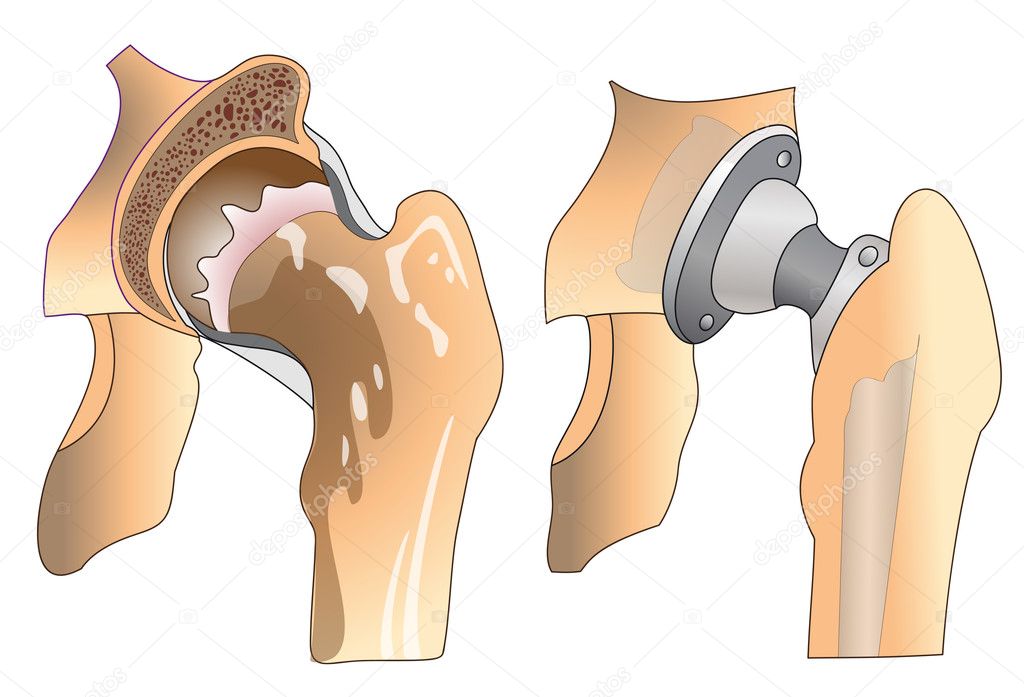 hip-prosthesis-stock-vector-maryna-melnyk-7163029