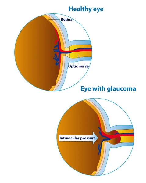Glaucoom — Stockvector