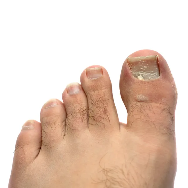 Pęknięty grzyb toe paznokci — Zdjęcie stockowe