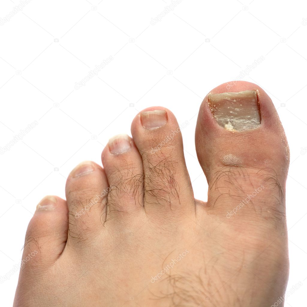 Cracked Fungus Toe Nail