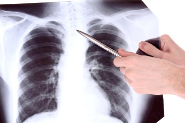 beyaz izole göğüs x-ray görüntüsü. bir şey p ile gösterilen