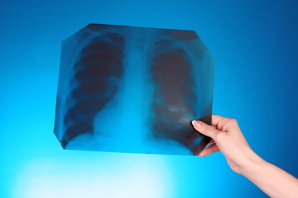 X-Ray Image of chest on blue background in hand — Stock Photo, Image