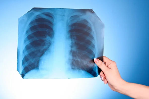 Ακτινογραφία εικόνα του στήθους σε μπλε φόντο στο χέρι — Φωτογραφία Αρχείου
