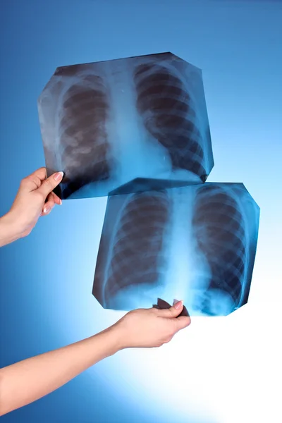 Два рентгеновских снимка груди на синем фоне в руке — стоковое фото