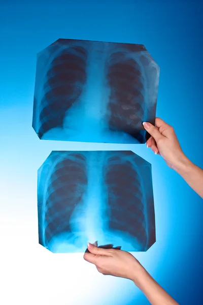 X-ışını iki göğüs üzerinde mavi arka plan görüntülerini el — Stok fotoğraf