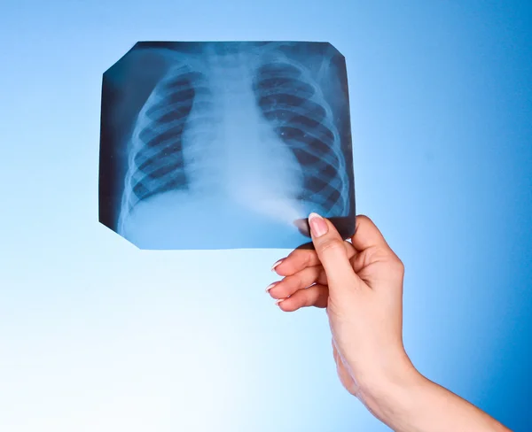 Ακτινογραφία εικόνα του στήθους σε μπλε φόντο στο χέρι — Φωτογραφία Αρχείου