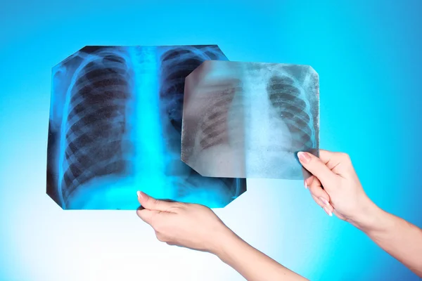 X-ray kép két mellkas a kék háttér a kezében. egy ember — Stock Fotó