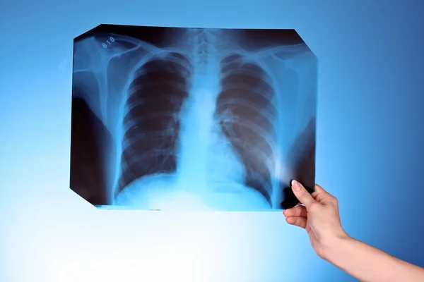 X 射线图像在蓝色背景上的胸部在手 — 图库照片