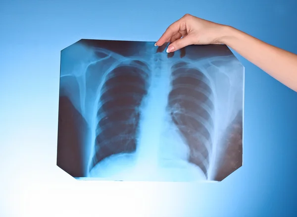 X-ray foto van borst op blauwe achtergrond in de hand — Stockfoto