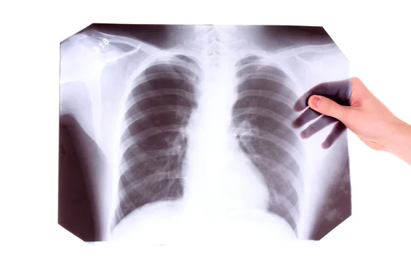 X-ray foto van borst geïsoleerd op wit. iets met p weergegeven: — Stockfoto