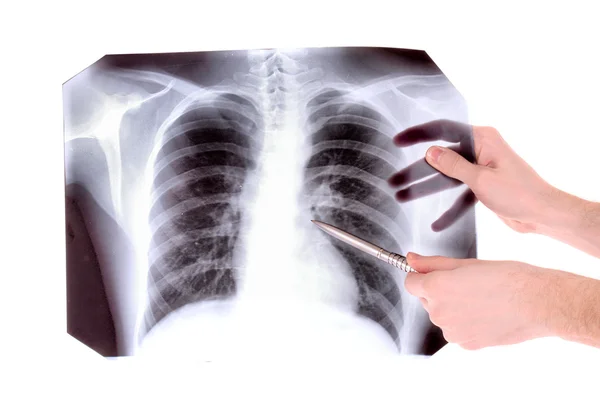 Beyaz izole göğüs x-ray görüntüsü. bir şey p ile gösterilen — Stok fotoğraf