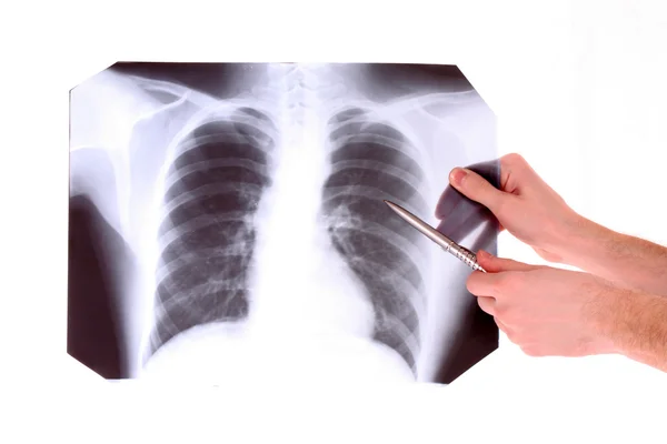 X-Ray Image of chest isolated on white. Showing something with p — Stock Photo, Image