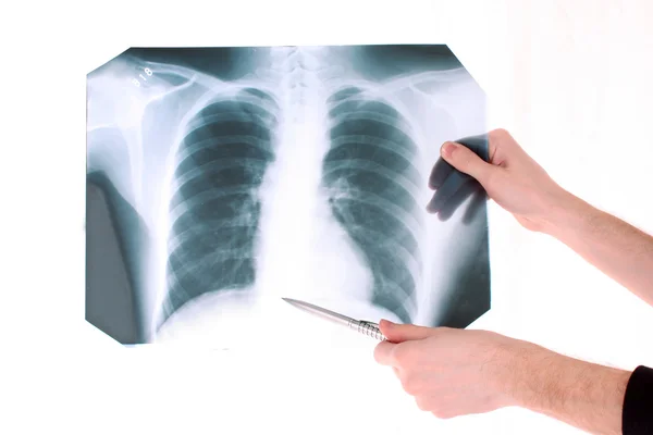 Zdjęcie rentgenowskie klatki piersiowej na białym tle. Wyświetlono coś z p — Zdjęcie stockowe