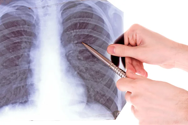 Röntgenbild der Brust isoliert auf weiß. etwas mit p zeigen — Stockfoto