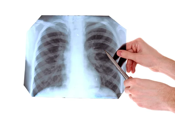 Рентгеновский снимок груди, изолированный на белом. Снимать что-то с p — стоковое фото