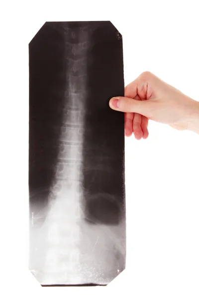 Röntgenbild der Wirbelsäule isoliert auf weiß. Zeigen mit Stift — Stockfoto