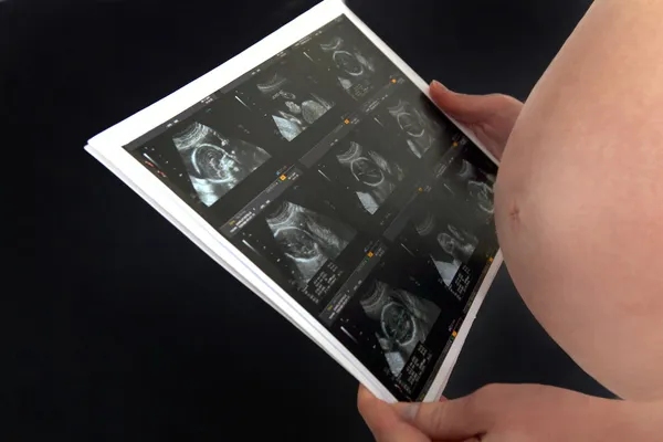 Een zwangere vrouw kijkt naar haar echografie. — Stockfoto
