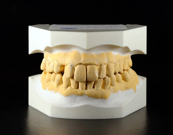 Plaster cast of the dental arch — Stock Photo, Image