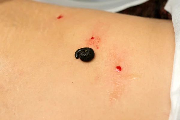 Blood sucking leech on the stomach, end medical treatment — Stock Photo, Image