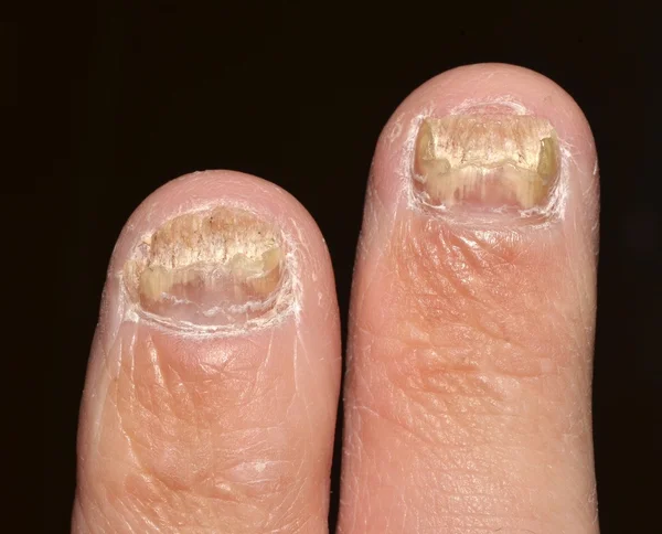 Грибок ногтей — стоковое фото