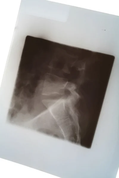 Radiographie médicale de la colonne vertébrale — Photo