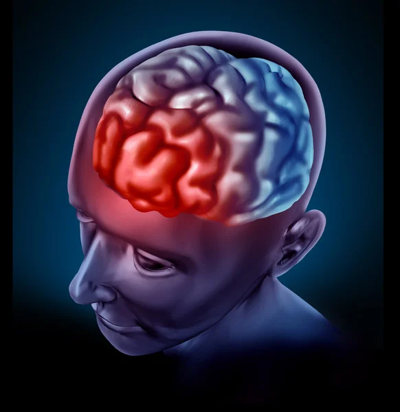 Migrain hlava — Stock fotografie