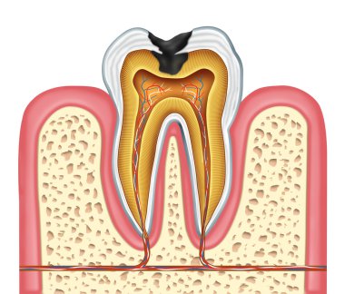 Tooth inner anatomy of a cavity clipart