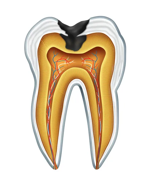 Cavidade dentária — Fotografia de Stock