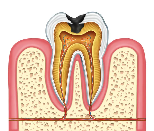 Anatomia interna do dente de uma cavidade — Fotografia de Stock