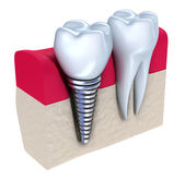 Zahnimplantat - implantiert in Kieferknochen. isoliert auf weiß