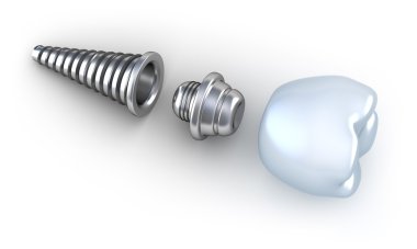 Dental implant 3d crown clipart
