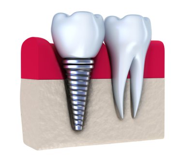 Dental implant - implanted in jaw bone. Isolated on white clipart