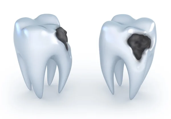 Dentes com cárie, imagem 3D . — Fotografia de Stock
