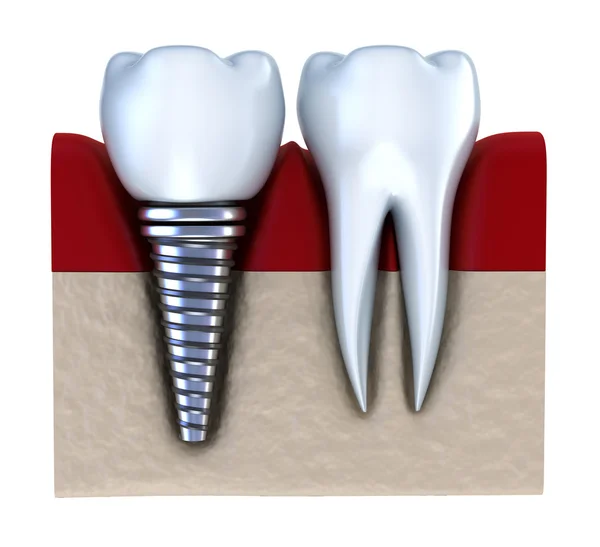 Dental implant - implanted in jaw bone. Isolated on white — Stock Photo, Image