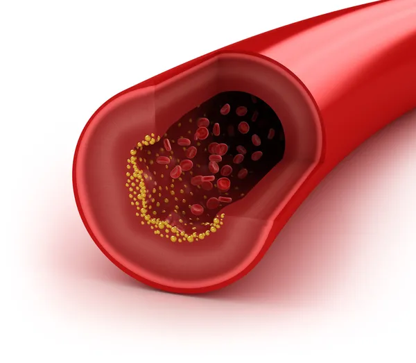 Cholesterin-Plaque in der Arterie, Konzept auf weiß isoliert — Stockfoto