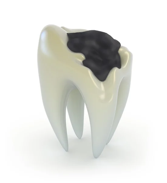 Tooth met cariës — Stockfoto