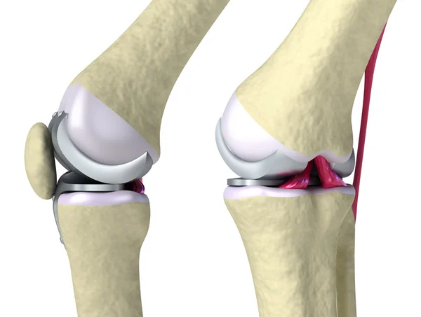 Knee and titanium hinge joint. Isolated on white — Stock Photo, Image