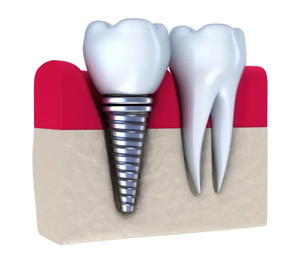 Implante dental implantado en el hueso de la mandíbula. Aislado sobre blanco —  Fotos de Stock