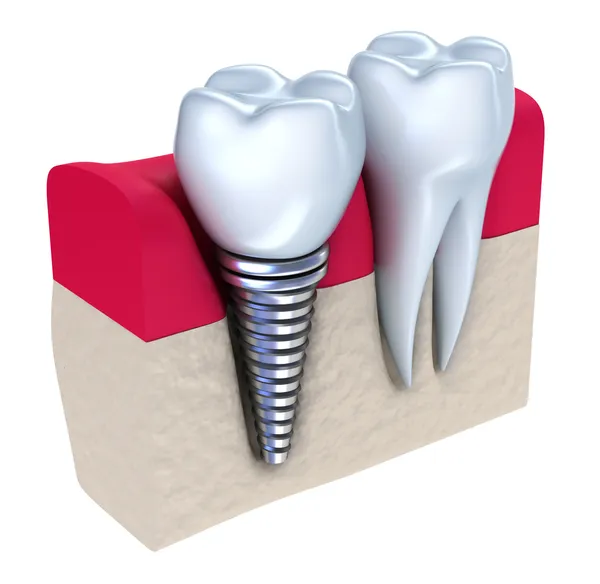 Implante dentário implantado no osso da mandíbula. Isolado em branco Imagens Royalty-Free