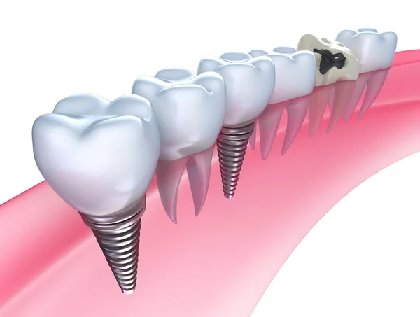 Zahnimplantate im Zahnfleisch - isoliert auf weiß — Stockfoto