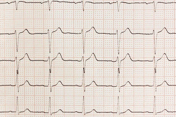 Elektrokardiyogram sonuç — Stok fotoğraf