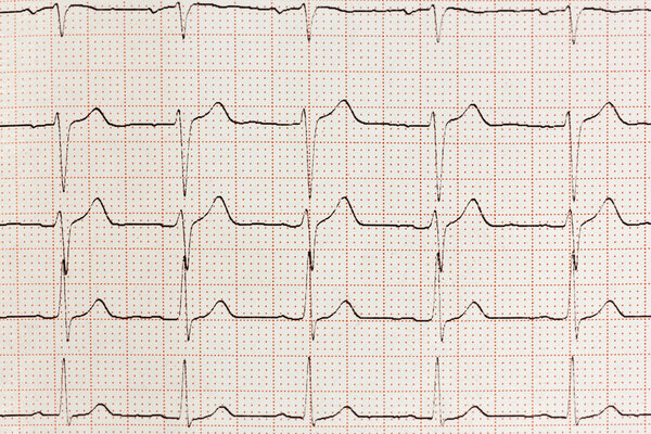 Electrocardiogram Result